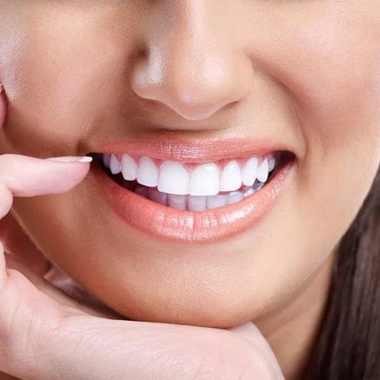 Dental Veneers Services Dubai
